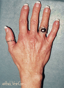 Hand Veins After Treatment at Schick VeinCare