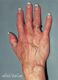 Hand Veins Before Treatment at Schick VeinCare