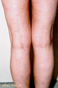 Leg Veins After Treatment at Schick VeinCare