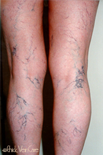Leg Veins Before Treatment at Schick VeinCare