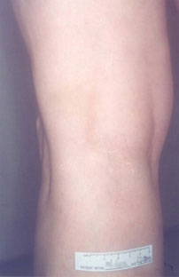 Reticular Veins After Treatment at Schicik VeinCare