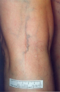Reticular Veins Before Treatment at Schick VeinCare