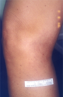Spider Veins After Treatment at Schick VeinCare