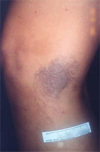 Spider Veins Before Treatment at Schick VeinCare