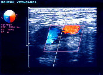 Color Ultrasound Diagnostic Image at Schick VeinCare