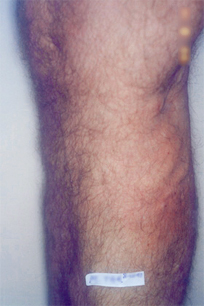 Varicose Veins After Treatment at Schick VeinCare