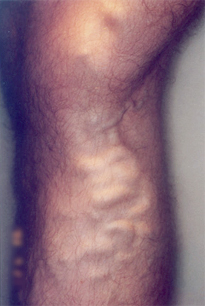 Varicose Veins Before Treatment at Schick VeinCare